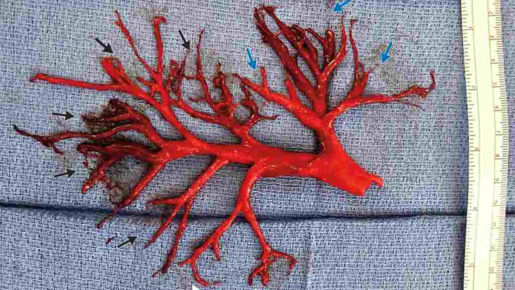 Apa Itu Muntah Darah dan Bagaimana Ciri-Cirinya